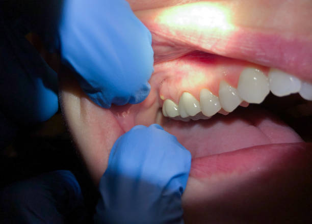Emergency Dental Filling Replacement in HI